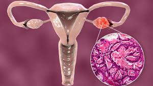 ओवेरियन सिस्ट (Ovarian Cysts) के कारण होने वाले पेल्विक और लोअर बैक पेन को कैसे पहचानें?