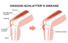 ओसगुड-श्लाटर रोग (Osgood-Schlatter Disease) बढ़ते बच्चों के घुटने का दर्द।