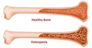 ओस्टियोपेनिया (Osteopenia) यह ऑस्टियोपोरोसिस से पहले की स्टेज है, डाइट और व्यायाम से इसे वापस कैसे पलटें (Reverse करें)।
