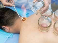 कपिंग थेरेपी (Cupping) ड्राई, वेट और फायर कपिंग - पुराने दर्द के लिए ये कैसे काम करते हैं।