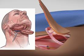 कैंसर मरीजों में रेडिएशन के कारण जबड़े के जाम होने (Radiation Trismus) का फिजियो इलाज