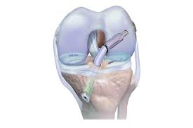 कोलेजन (Collagen) और लिगामेंट एसीएल (ACL) सर्जरी के बाद कौन सा सप्लीमेंट लिगामेंट को मजबूत करता है?