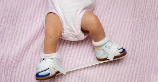 क्लबफुट (Clubfoot) जन्मजात टेढ़े पैरों का पोंसेटी (Ponseti) मेथड और स्ट्रेचिंग।