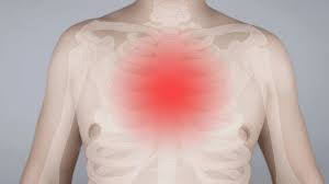 टिट्ज़ सिंड्रोम (Tietze Syndrome) छाती की पसलियों में बिना हार्ट की बीमारी के होने वाली सूजन और दर्द।