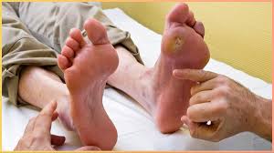 डायबिटिक न्यूरोपैथी (पैरों का सुन्न होना): नसों में ब्लड फ्लो बढ़ाने के लिए एनोडाइन (Anodyne) थेरेपी