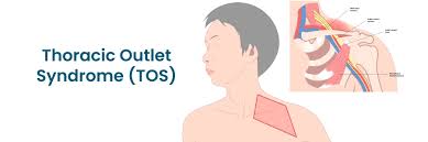 थोरैसिक आउटलेट सिंड्रोम (TOS) गर्दन से लेकर उंगलियों तक सुन्नपन—क्या आपकी नसें पसलियों में दब रही हैं?