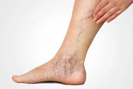 दुकानदारों के लिए दिन भर खड़े रहने के कारण वैरिकोज वेन्स (Varicose Veins) से बचाव।