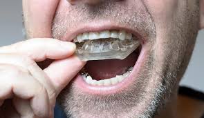 नींद में दांत किटकिटाना (Bruxism): जबड़े के दर्द (TMJ) के लिए नाइट-गार्ड (Night Guard) और रिलैक्सेशन