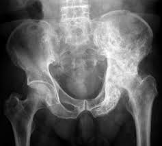 पगेट रोग (Paget's Disease) हड्डियों के असामान्य रूप से मोटे होने पर फिजियो केयर।