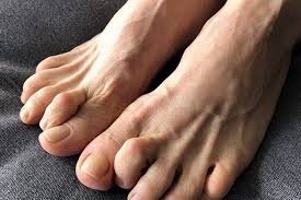 पैरों की उंगलियों से जमीन को पकड़ना (Toe Gripping): टाइट जूतों की वजह से नर्वस सिस्टम का खराब रिस्पांस