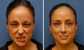 फेशियल पाल्सी (Bell's Palsy) रिकवरी पीएनएफ (PNF) तकनीक से चेहरे के व्यायाम।