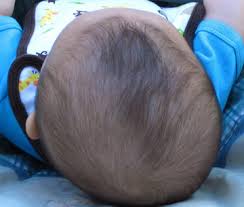फ्लैट हेड सिंड्रोम (Plagiocephaly) शिशुओं के सिर के आकार को ठीक करने के व्यायाम।