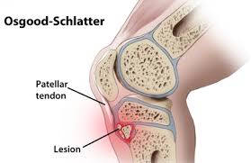 बच्चों में 'ओसगूड-श्लाटर' (Osgood-Schlatter): तेज दौड़ने वाले किशोरों के घुटने के नीचे की हड्डी का उभरना और दर्द