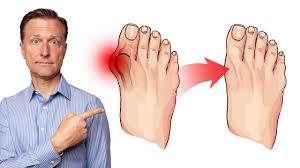 बनियनेक्टॉमी (Bunionectomy): पैर के अंगूठे की हड्डी कटवाने के बाद फुट-आर्च को फिर से कैसे बनाएं?