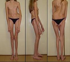 मारफन सिंड्रोम (Marfan Syndrome) अत्यधिक लंबी हड्डियों और लचीले जोड़ों वाले मरीजों के लिए व्यायाम।