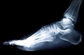 मिथक या सच एक्स-रे में हड्डी बढ़ी हुई (Osteophyte) दिखे, तो दर्द होना तय है।