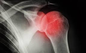 मैदान पर एथलीट का कंधा खिसक जाए (Shoulder Dislocation), तो अस्पताल पहुंचने से पहले क्या करें और क्या न करें?