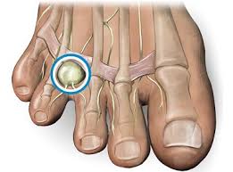 मॉर्टन न्यूरोमा (Morton's Neuroma) पैरों की उंगलियों के बीच दर्द (जैसे जूते में पत्थर हो)।