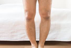 रिकेट्स (सूखा रोग): विटामिन डी की गंभीर कमी से मुड़े हुए पैरों (Bowed Legs) का मेडिकल और फिजियो मैनेजमेंट