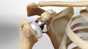 रिवर्स शोल्डर रिप्लेसमेंट (Reverse Shoulder Arthroplasty): रोटेटर कफ पूरी तरह फट जाने पर यह सर्जरी कैसे काम करती है?