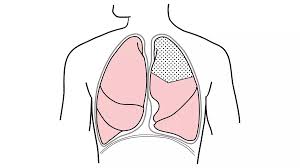 लंग कैंसर सर्जरी (Lobectomy) के बाद फेफड़ों को फिर से फैलाने के लिए इन्सेन्टिव स्पाइरोमेट्री
