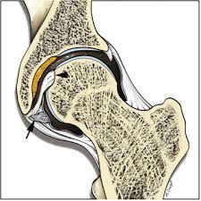 'लिगामेंटम टेरेस' (Ligamentum Teres): कूल्हे (Hip) के इस अनदेखे लिगामेंट की चोट को कैसे पहचानें?