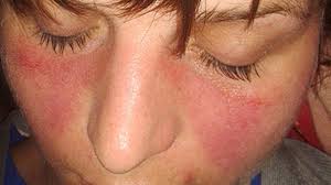ल्यूपस (Lupus) इस ऑटोइम्यून बीमारी में जोड़ों के दर्द और अत्यधिक थकान का फिजियो प्रबंधन।