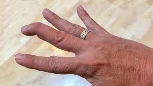 वॉलीबॉल बार-बार उंगलियों में लगने वाली चोट (Mallet Finger) का इलाज।