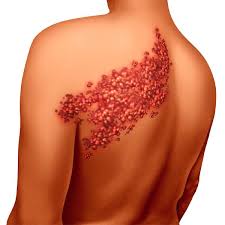 शिंगल्स (Shingles) दाद या हर्पीस के बाद होने वाले भयंकर नसों के दर्द (PHN) में फिजियोथेरेपी।