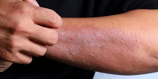 सार्कोइडोसिस (Sarcoidosis) इस बीमारी में सांस फूलने और मांसपेशियों की थकान का इलाज।