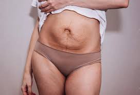 सिजेरियन (C-Section) के स्कार (निशान) के कारण सालों बाद होने वाले लोअर बैक पेन का इलाज