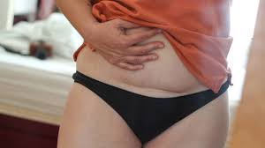सिजेरियन डिलीवरी (C-Section) के 5 साल बाद भी पेट की मांसपेशियों का कमजोर रहना: कारण और उपाय