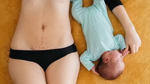 सी-सेक्शन (C-Section) स्कार मसाज डिलीवरी के बाद पेट के टांकों के निशान की मसाज कैसे करें।