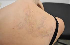 स्कार टिश्यू रिलिजिंग (Scar Tissue Release): टैटू (Tattoo) बनवाने के बाद उस जगह की स्किन टाइटनेस का मस्कुलर प्रभाव