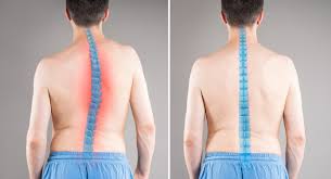 स्कोलियोसिस (Scoliosis) की सर्जरी (Spinal Fusion) के बाद खेल-कूद (Return to Sport) में वापसी