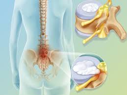 स्लिप डिस्क (L5-S1) का दर्द बिना ऑपरेशन कैसे ठीक करें?