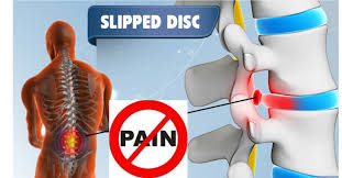 स्लिप डिस्क की हीलिंग (Resorption) क्या अपनी जगह से बाहर निकली हुई डिस्क बिना सर्जरी के वापस अंदर जा सकती है