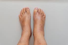 हार्ट फेलियर (CHF) के मरीजों के लिए पैरों की सूजन (Edema) कम करने के लिए टखने के व्यायाम