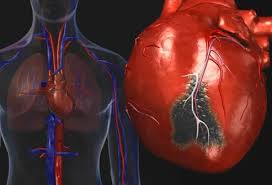 हार्ट बाईपास (CABG) हार्ट सर्जरी से पहले फेफड़ों की क्षमता बढ़ाने की तैयारी।