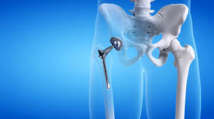 हिप सर्जरी (Hip Replacement) कूल्हा बदलने के ऑपरेशन से पहले मांसपेशियों को मजबूत करने के फायदे।