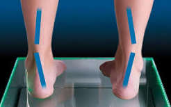 अंडरप्रोनेशन (Supination) पैरों के बाहरी हिस्से पर ज्यादा जोर पड़ने से घुटनों पर पड़ने वाला दबाव।