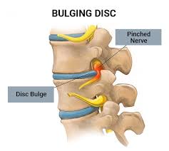 अगर आपकी एमआरआई रिपोर्ट में स्लिप डिस्क (Disc Bulge) आया है, तो आपको सर्जरी ही करवानी पड़ेगी।