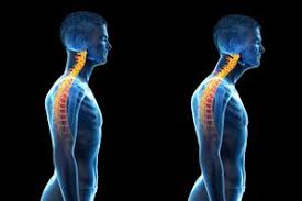 अपर क्रॉस्ड सिंड्रोम गर्दन आगे (Forward Head) और कंधे गोल होने का न्यूरोलॉजिकल और मस्कुलर पैटर्न।