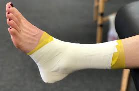 एंकल टेपिंग (Ankle Taping) बार-बार टखना मुड़ने या मोच आने से बचने के लिए खिलाड़ियों द्वारा की जाने वाली टेपिंग।