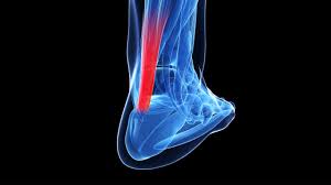 एच्लीस टेंडिनाइटिस (Achilles Tendinitis) धावकों और बैडमिंटन खिलाड़ियों में एड़ी की पिछली नस का दर्द और इलाज।