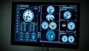 एमआरआई (MRI) रिपोर्ट समझना अपनी रिपोर्ट में 'बल्ज' (Bulge) और 'हर्नियेशन' (Herniation) के बीच का अंतर जानें।
