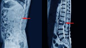एमआरआई डिकोड रिपोर्ट में 'बल्ज' (Disc Bulge) और 'हर्नियेशन' (Herniation) के बीच का तकनीकी अंतर।