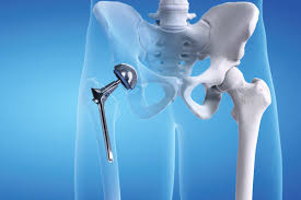 कूल्हा प्रत्यारोपण (Hip Replacement) सर्जरी के बाद पहले 6 हफ्तों में बैठने, लेटने और करवट लेने के कड़े नियम।
