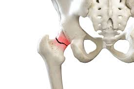 कूल्हे के फ्रैक्चर के बाद (Hip Fracture) बिस्तर पर लंबे समय तक रहने से होने वाले निमोनिया और बेडसोर से बचाव।
