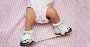क्लबफुट (Clubfoot) जन्मजात टेढ़े पैरों को बिना सर्जरी के प्लास्टर (Ponseti method) से कैसे सीधा करें।